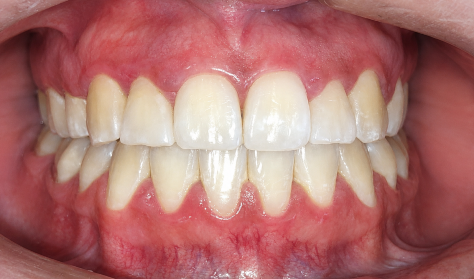Foto intraoral depois do tratamento ortodôntico — caso 1